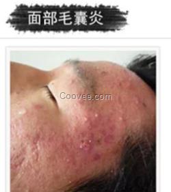 引起毛囊炎最主要的原因 毛囊炎能治好吗