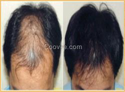 3个月的<em>宝宝</em>有掉<em>头发</em>脱发防<em>脱</em>脉塔瑶元堂