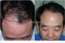 <em>哺乳期</em>掉<em>头发</em>严重脱发防<em>脱</em>脉塔瑶元堂