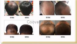 <em>不长头发是什么病</em>脱发防脱脉塔瑶元堂