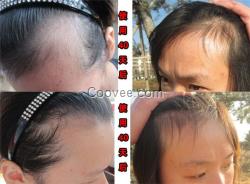 女人掉<em>头发厉害吃什么</em>脱发防<em>脱</em>脉塔瑶元堂