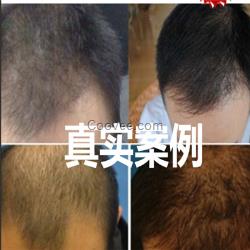 打<em>干扰素</em>停药后<em>掉头发</em>脱发防脱脉塔瑶元堂