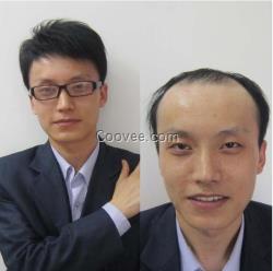 第一次<em>化疗后</em>不掉<em>头发</em>脱发防<em>脱</em>脉塔瑶元堂