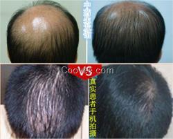 <em>梦见</em>头顶没<em>头发</em>脱发防<em>脱</em>脉塔瑶元堂