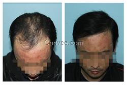 <em>20多岁掉头发</em>防脱止脱品牌推荐瑶元堂