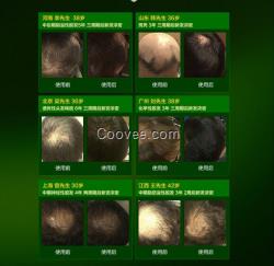 <em>青少年</em>长<em>白头发原因</em>